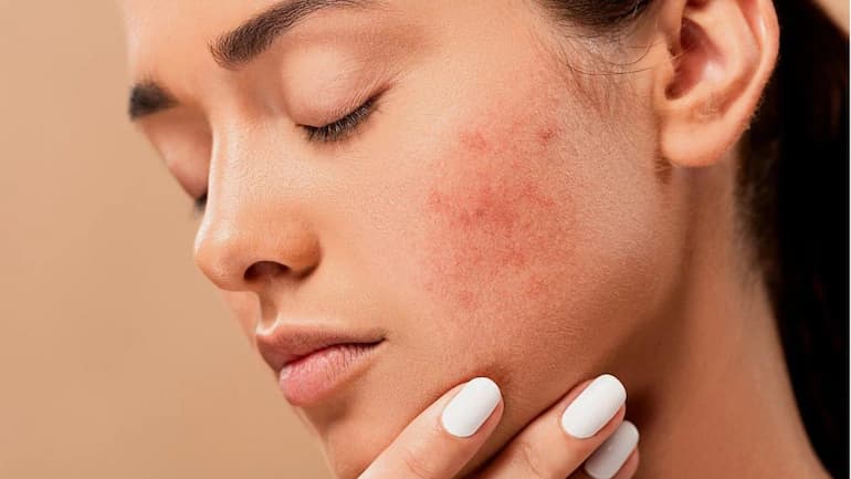 How to Fight With Acne