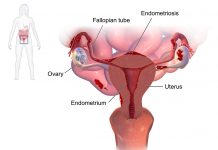 Useful information about endometriosis and pregnancy