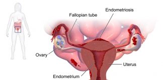 Useful information about endometriosis and pregnancy