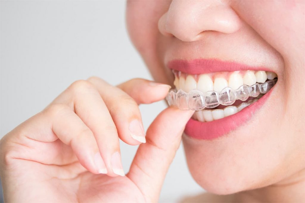 What You Need to Know Before Going Through an Invisalign Procedure