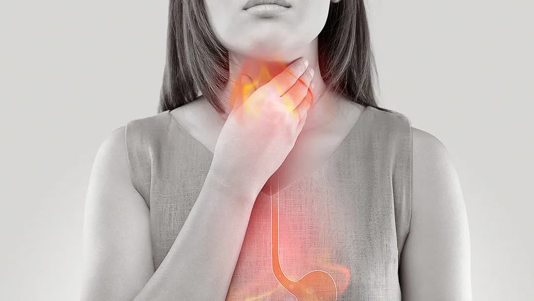 Natural Remedies for Acid Reflux Effective Relief Without Medication